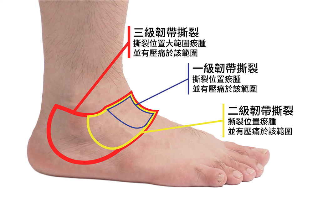 自診足踝扭傷 (拗柴)